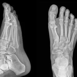 An x-ray image of a man's foot with a top and side angle view